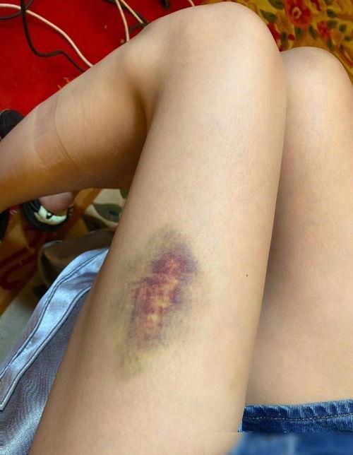 大腿黑青照片,成因与预防攻略